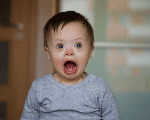 Baby boy with downsyndrome. Baby boy with downsyndrome.